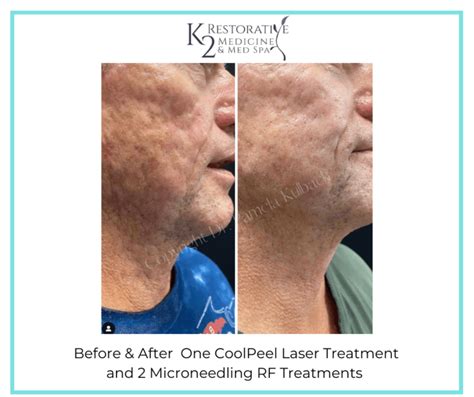 Tetra Co2 Laser And Coolpeel™ The Latest In Laser Skin Resurfacing