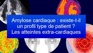 Amyloses Cardiaques