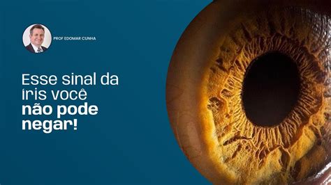 Esse Sinal Da íris Você Não Pode Negar Prof Edomar Cunha Iridologia