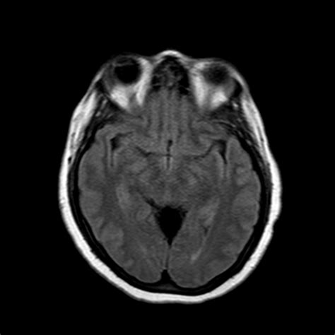 Quadrigeminal Cistern Arachnoid Cyst Image