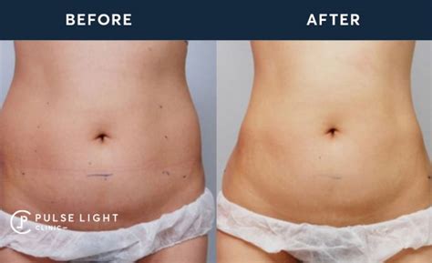 Hifu Skin Tightening Pulse Light Clinic London