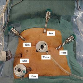 Port placement. (A) Port placement using the medial to lateral approach ...