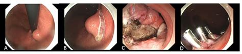 IDDF2024 ABS 0114 The Necessity Of Resection For Small Submucosal