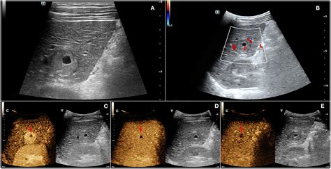 Frontiers Contrast Enhanced Ultrasound Findings Of Hepatocellular