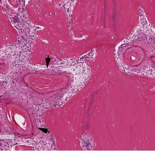 Microscopic Examination Showing Infiltrative Squamous Cell Nests