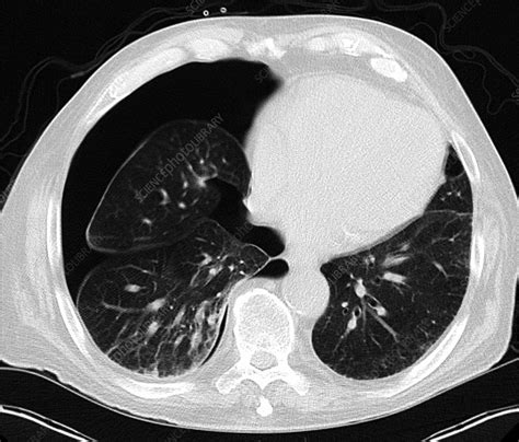 Ct Axial Tension Pneumothorax Stock Image C0366390 Science Photo