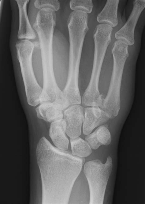 Metacarpal X Ray