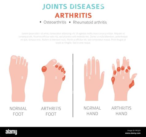 Enfermedades De Las Articulaciones Los S Ntomas De La Artritis El