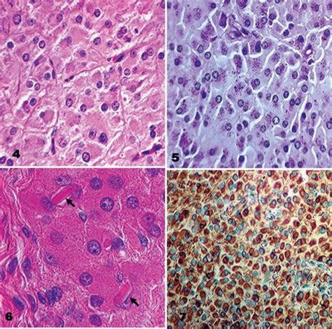 An In Depth Look At Leydig Cell Tumor Of The Testis Archives Of