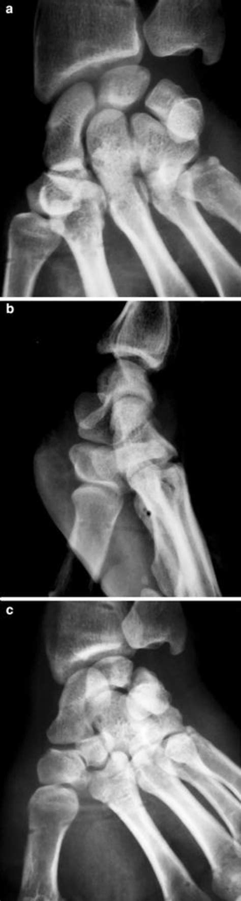 Four Week Postoperative Radiographs Anteroposterior Lateral And