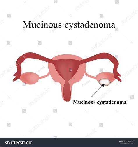 Mucinous Cyst On Ovary Cystadenoma Ovary 스톡 일러스트 373478149