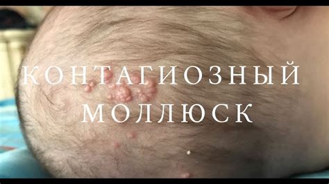 Моллюск на теле у детей фото