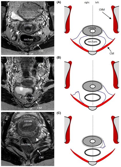 Axial 3 T Mri Images At The Level Of The Cervix And Appropriate Scheme Download Scientific