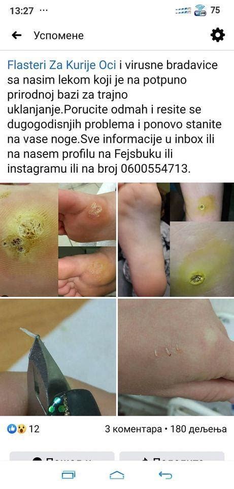 Flasteri Za Kurije Oci Virusne Bradavice I Urasle Nokte Beograd