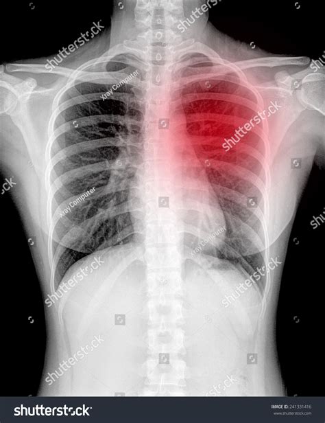 Xray Image Human Healthy Chest Mri Stock Photo Shutterstock