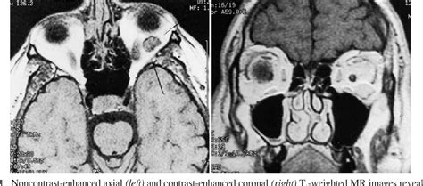 Figure 1 From Intrasellar Cavernous Hemangioma Case Report Semantic