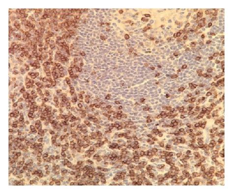 (a) Histology of the tissue showed proliferation of lymphoid follicles ...