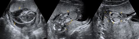 Turner Syndrome Pregnancy Aneuploidy What Is It Causes Diagnosis
