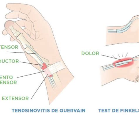 La Tendinitis O Tenosinovitis De Quervain Clínica López Corcuera