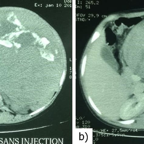 Renal CT scan. (a) Renal mass with central calcifications and large ...