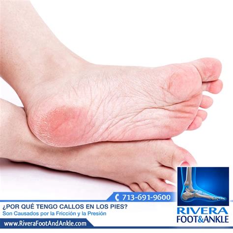 Rivera Foot And Ankle Por Qu Tengo Callos En Los Pies