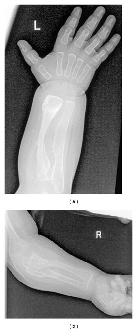 Swellings Over The Limbs As The Earliest Feature In A Patient With