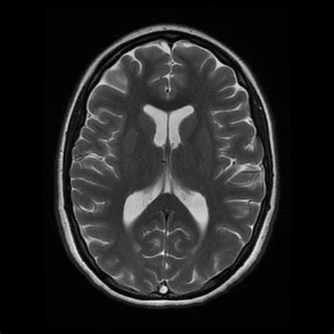 Superior Sagittal And Right Transverse Sinuses Thrombosis Image