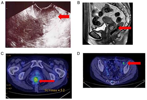 Recurrent Malignant Melanoma Of The Uterine Cervix Treated With Anti‑pd‑1 Antibodies And Anti