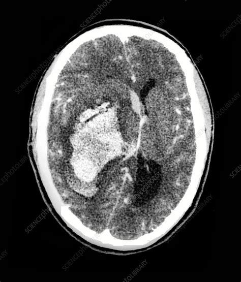 Stroke And Brain Damage CT Scan Stock Image C047 4982 Science