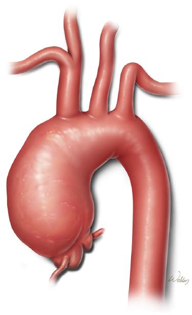 Ascending Aortic Aneurysm This Aneurysm Involves The Ascending