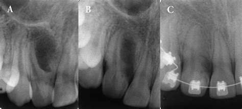 A Preoperative Radiograph Showing The Tooth With Severe Type Iii