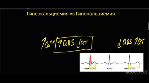 Гиперкальциемия и Гипокальциемия. ЭКГ - YouTube