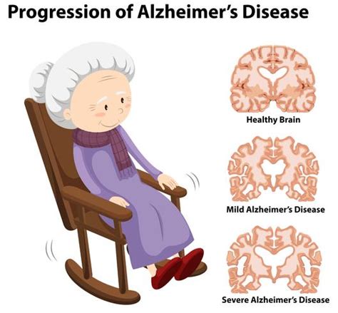 Progression of alzheimer's disease 302922 Vector Art at Vecteezy