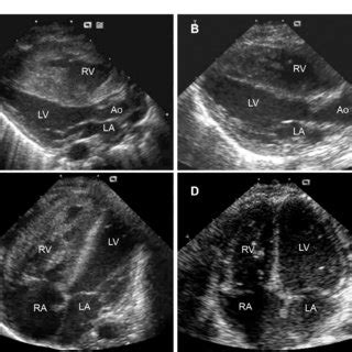 Transthoracic Echocardiogram Parasternal Long Axis View A And Apical