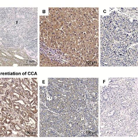 Immunohistochemical Detection Of Ass Expression In Paraffin Embedded