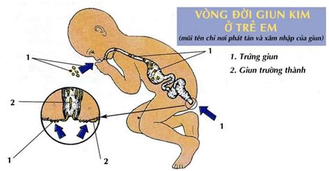 Dấu hiệu nhận biết trẻ nhiễm giun và thời điểm tẩy giun cho trẻ Bệnh