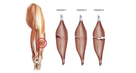 Desgarro Muscular Clínica MEDS