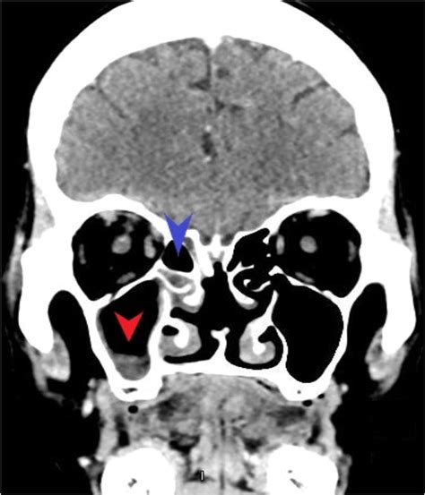 C.T. Head scan with contrast (coronal view) showing partial... | Download Scientific Diagram