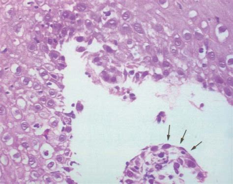 Pemphigus Vulgaris With Exclusive Involvement Of The Esophagus Case