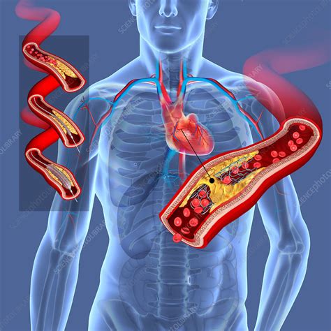 Angioplasty with stent placement, illustration - Stock Image - C046 ...