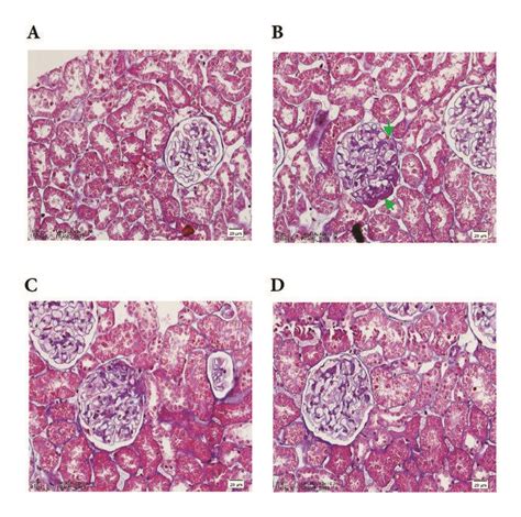 Renal Ultrastructural Changes In Rats With DN Can Be Reversed By ZY