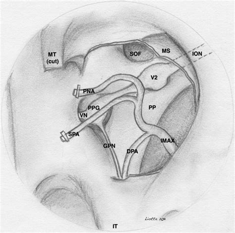 Endoscopic Management Of Juvenile Nasopharyngeal Angiofibromas