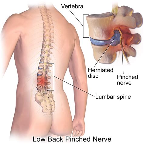 Pinched Nerve Treatment: Symptoms, Causes & Relief Options