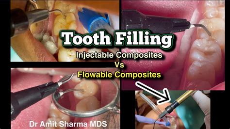 Tooth Filling Injectable Composite Vs Flowable Composite Best