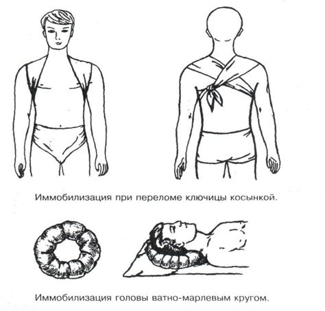 Транспортная иммобилизация виды способы