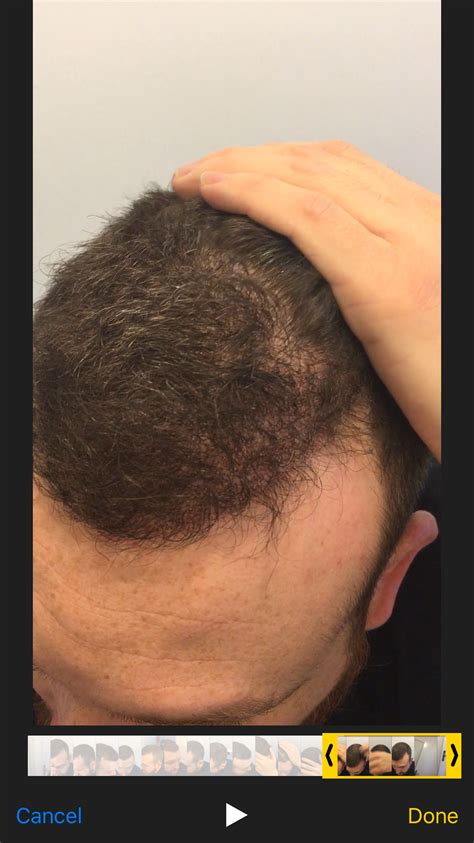 HLC Hairline Clinic Ankara FUE 3200 Grafts International Hair Loss Forum