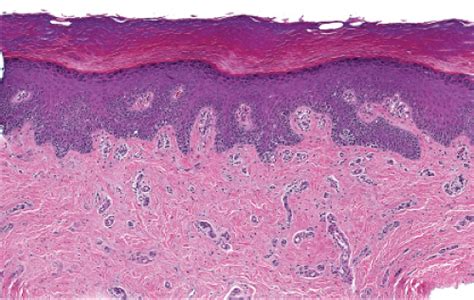 Localized Superficial Epidermal Or Melanocytic Proliferations Plastic