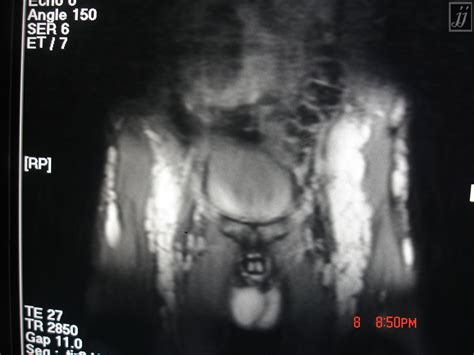 Spine Sacral Tumors Inguinal And Iliac Adenopathies Radioogle