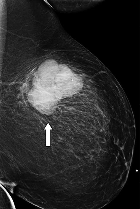 Phyllode Tumor