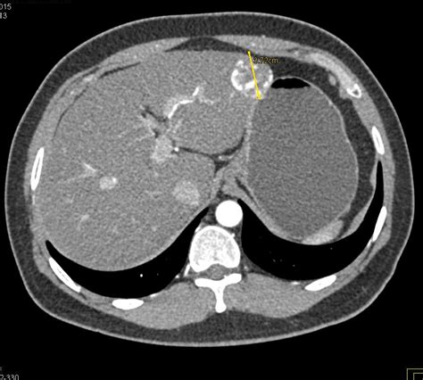 Hemangioma Liver Mri